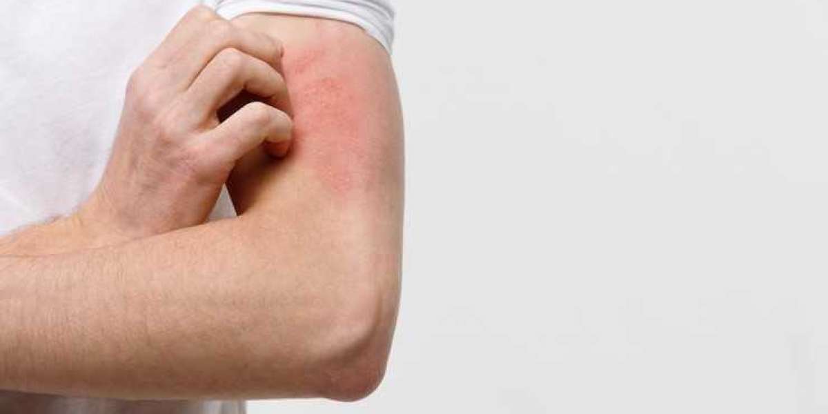 Ivermectin 12mg in Public Health: Fighting Parasites Globally